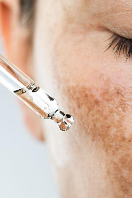 tranexamic-acid-for-melasma-a-dermatologists-secret-weapon-1.jpg